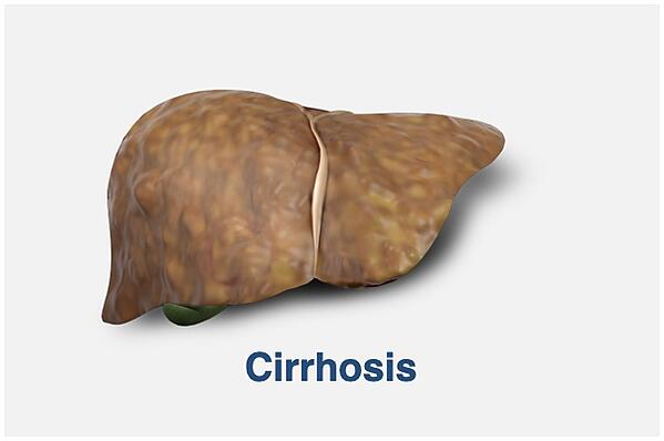 Cirrhosis
